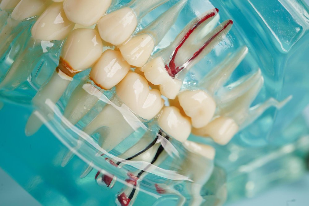 Dental bone grafting